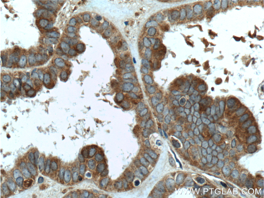 IHC staining of human ovary tumor using 11259-1-AP (same clone as 11259-1-PBS)