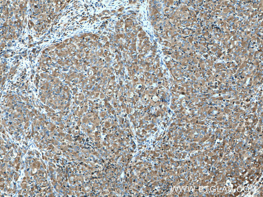 IHC staining of human lymphoma using 27834-1-AP