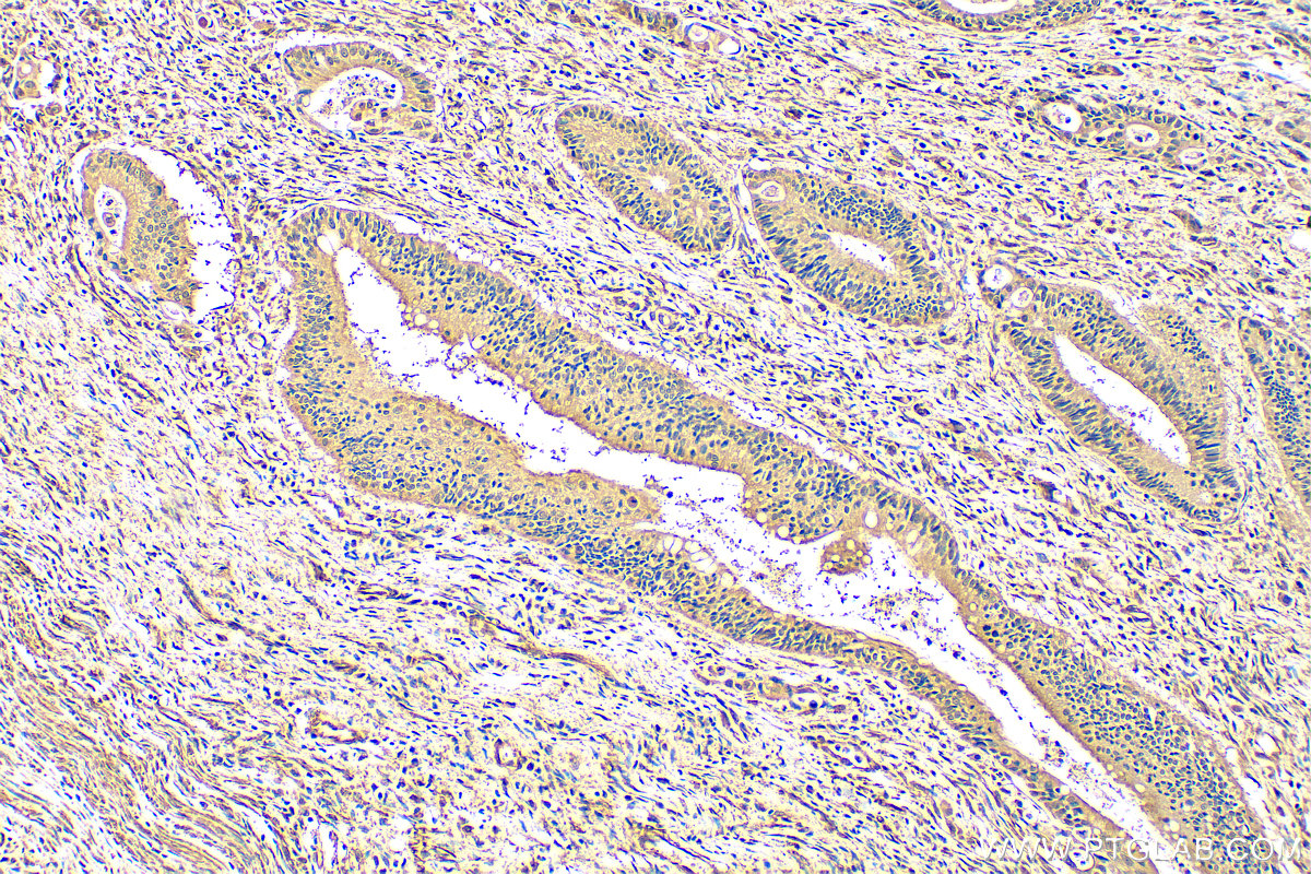 IHC staining of human colon cancer using 29756-1-AP (same clone as 29756-1-PBS)