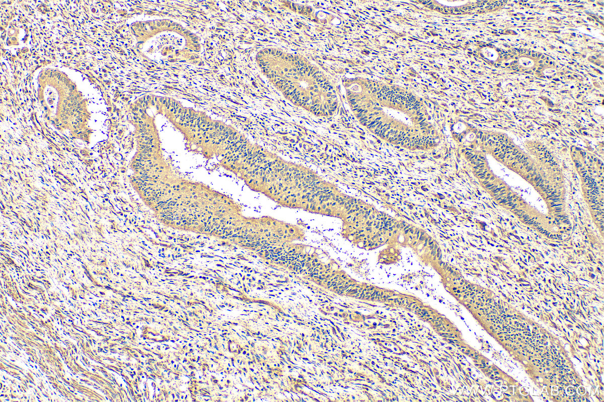 IHC staining of human colon cancer using 29756-1-AP