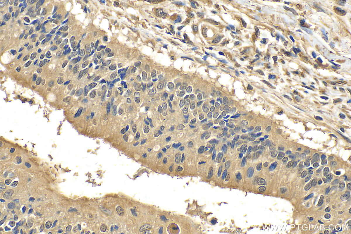 IHC staining of human colon cancer using 29756-1-AP (same clone as 29756-1-PBS)