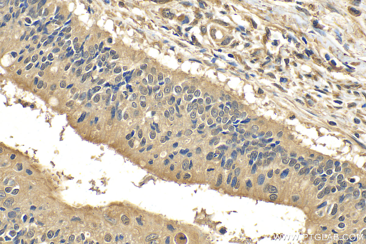 IHC staining of human colon cancer using 29756-1-AP