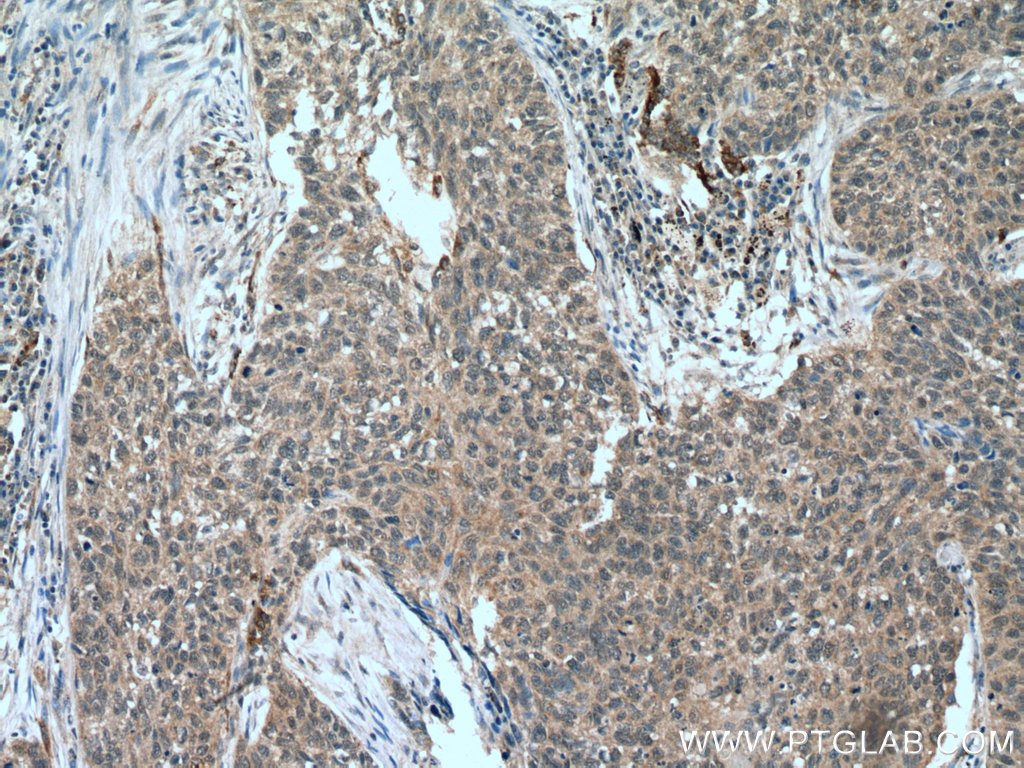 IHC staining of human lung cancer using 15725-1-AP