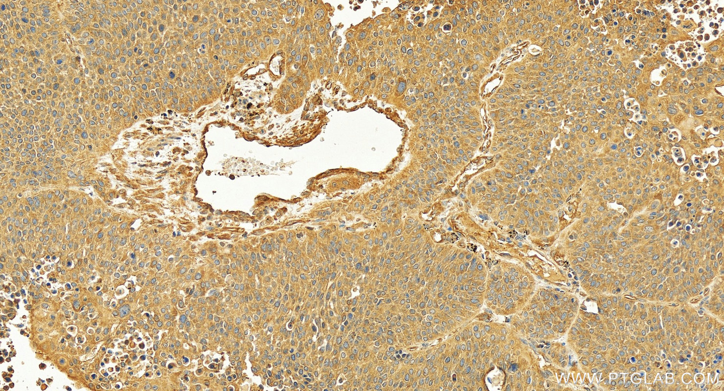 Immunohistochemical analysis of paraffin-embedded human lung squamous cell cancer slide using 16861-1-AP (FMO2-specific antibody) at dilution of 1:200 (under 20x lens). Heat mediated antigen retrieval with Tris-EDTA buffer (pH 9.0). IHC staining of human lung squamous cell cancer using 16861-1-AP