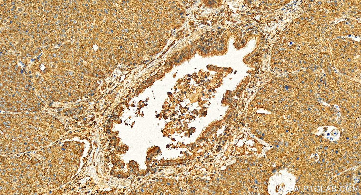 Immunohistochemical analysis of paraffin-embedded human lung squamous cell cancer slide using 16861-1-AP (FMO2-specific antibody) at dilution of 1:200 (under 20x lens). Heat mediated antigen retrieval with Tris-EDTA buffer (pH 9.0). IHC staining of human lung squamous cell cancer using 16861-1-AP