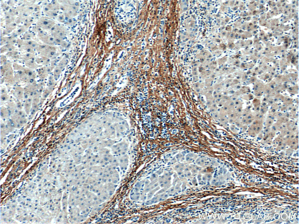 IHC staining of human hepatocirrhosis using 60108-1-Ig