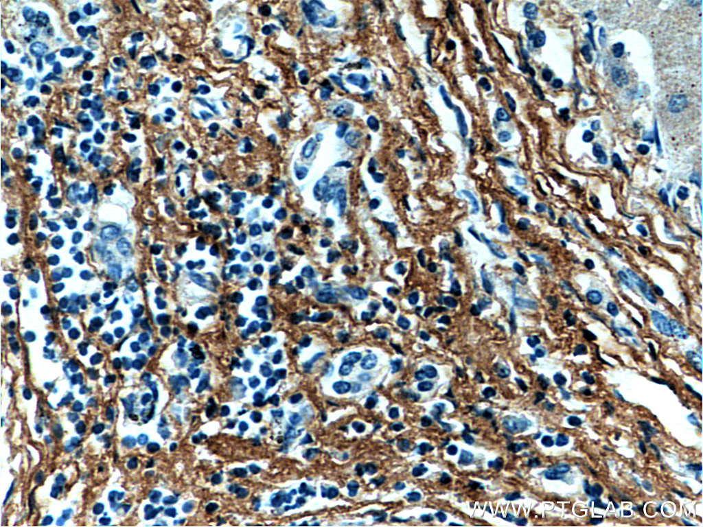 IHC staining of human hepatocirrhosis using 60108-1-Ig