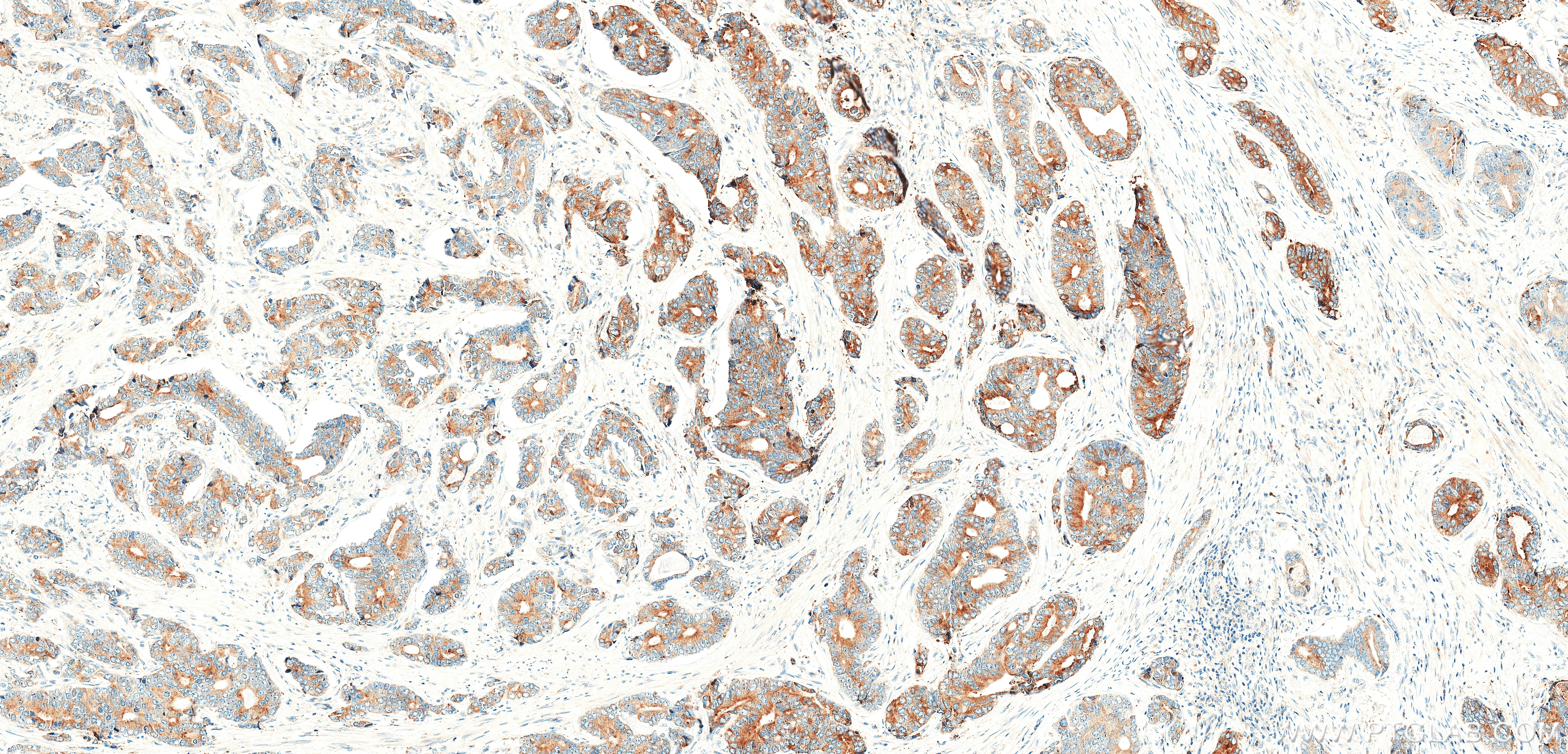 IHC staining of human prostate cancer using 87803-1-RR IHC staining of human prostate cancer using 87803-1-RR