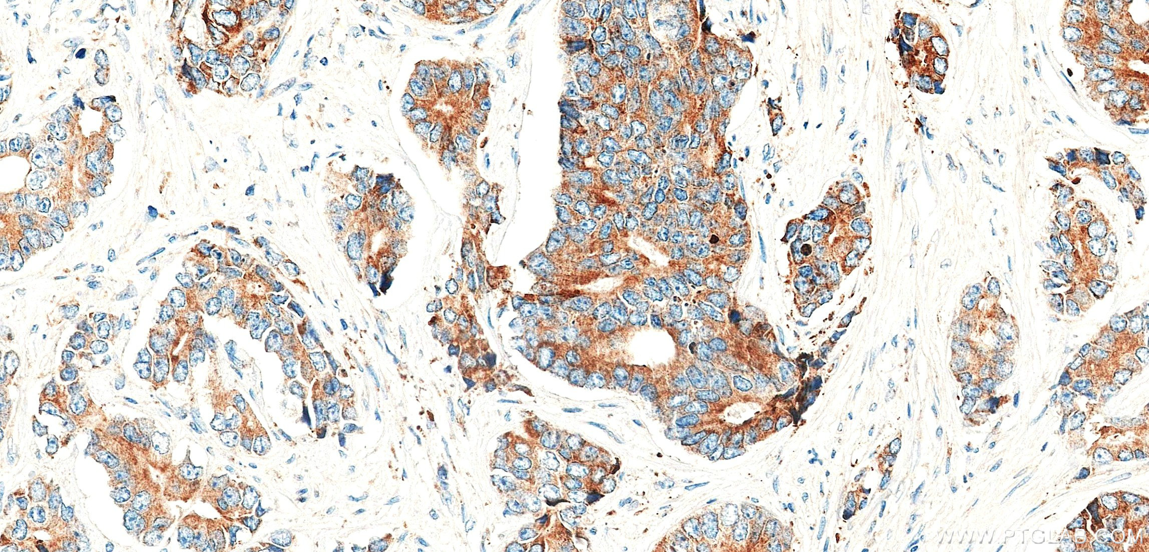 IHC staining of human prostate cancer using 87803-1-RR IHC staining of human prostate cancer using 87803-1-RR