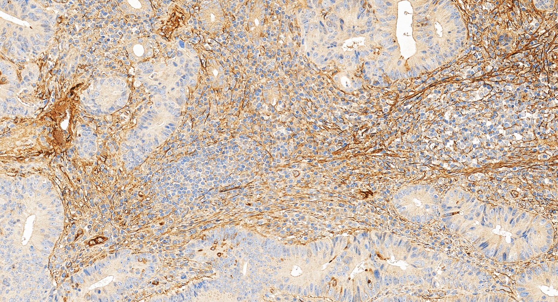 IHC staining of human colon cancer using 15613-1-AP