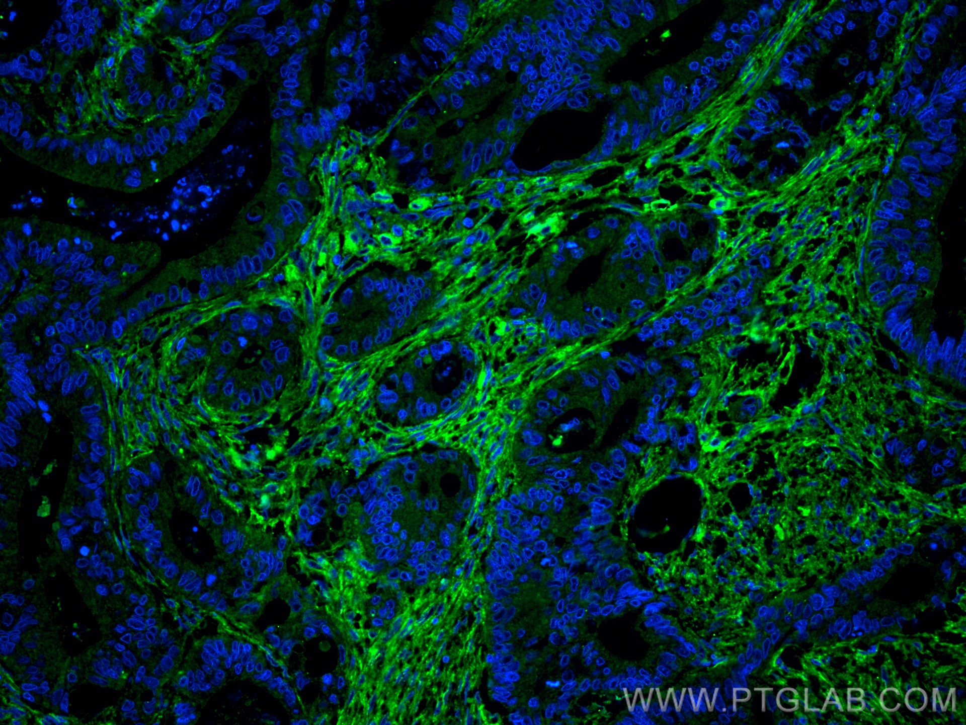 IF Staining of human colon cancer using 66042-1-Ig (same clone as 66042-1-PBS)