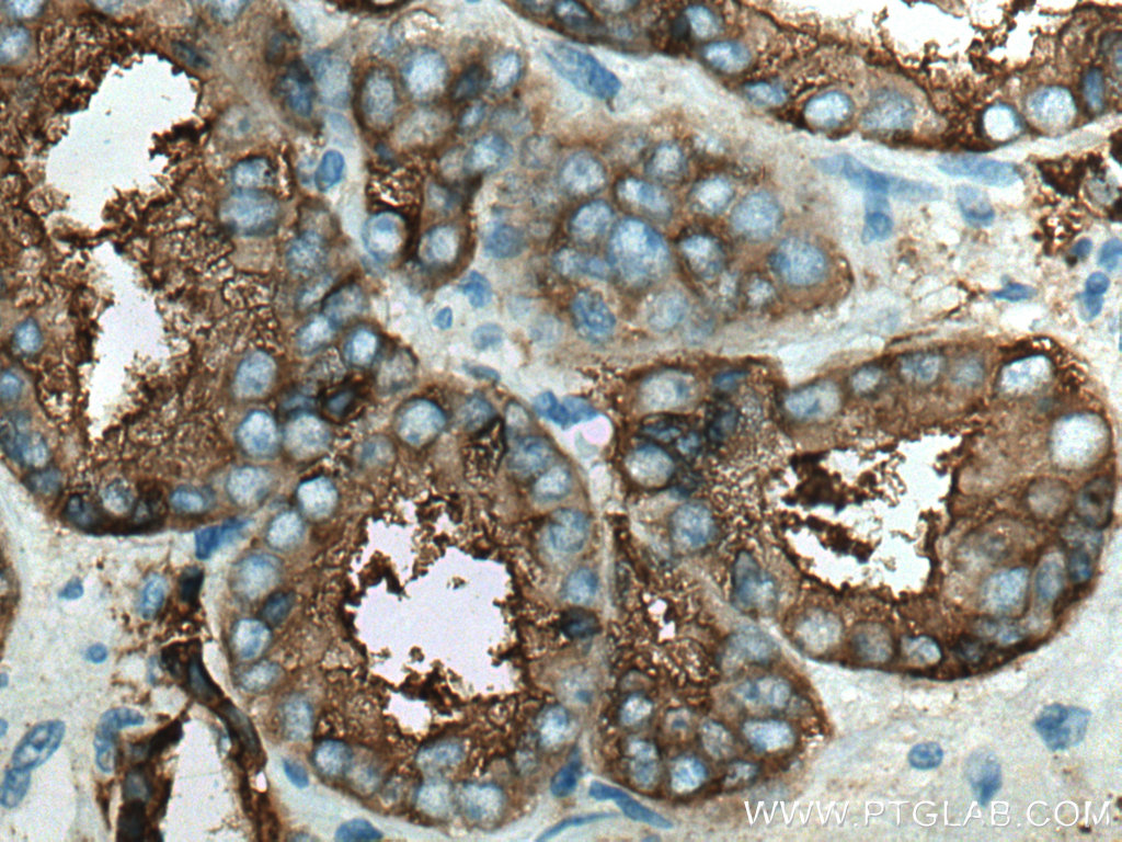 IHC staining of human prostate cancer using 66678-1-Ig