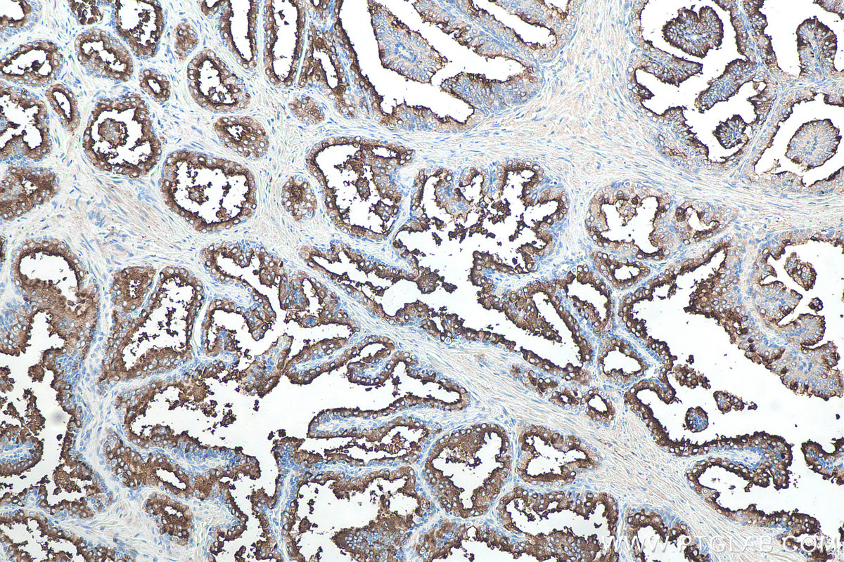 IHC staining of human prostate hyperplasia using 66678-1-Ig IHC staining of human prostate hyperplasia using 66678-1-Ig