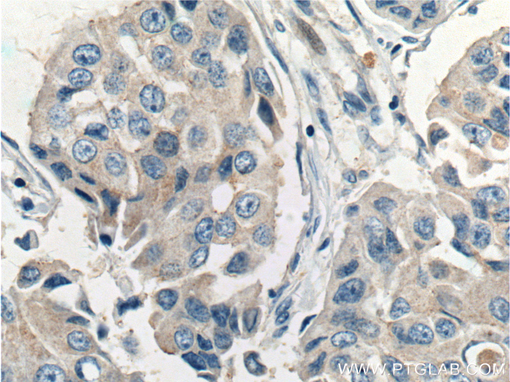 IHC staining of human breast cancer using 23355-1-AP