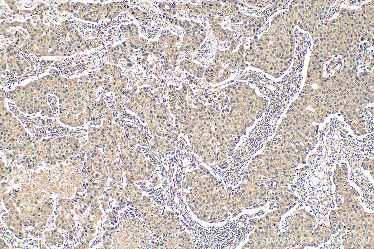 IHC staining of human breast cancer using 68384-1-Ig