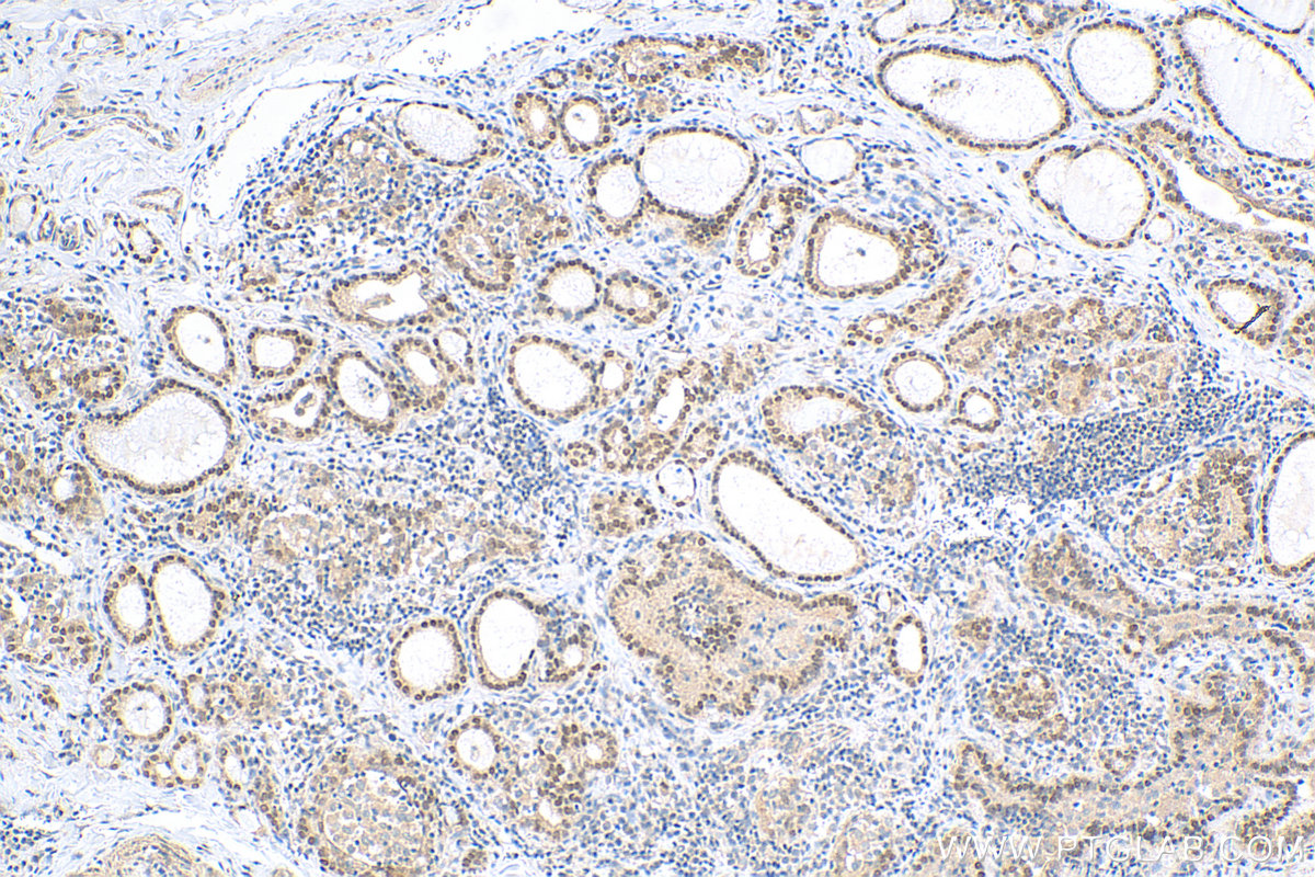 IHC staining of human thyroid cancer using 55363-1-AP
