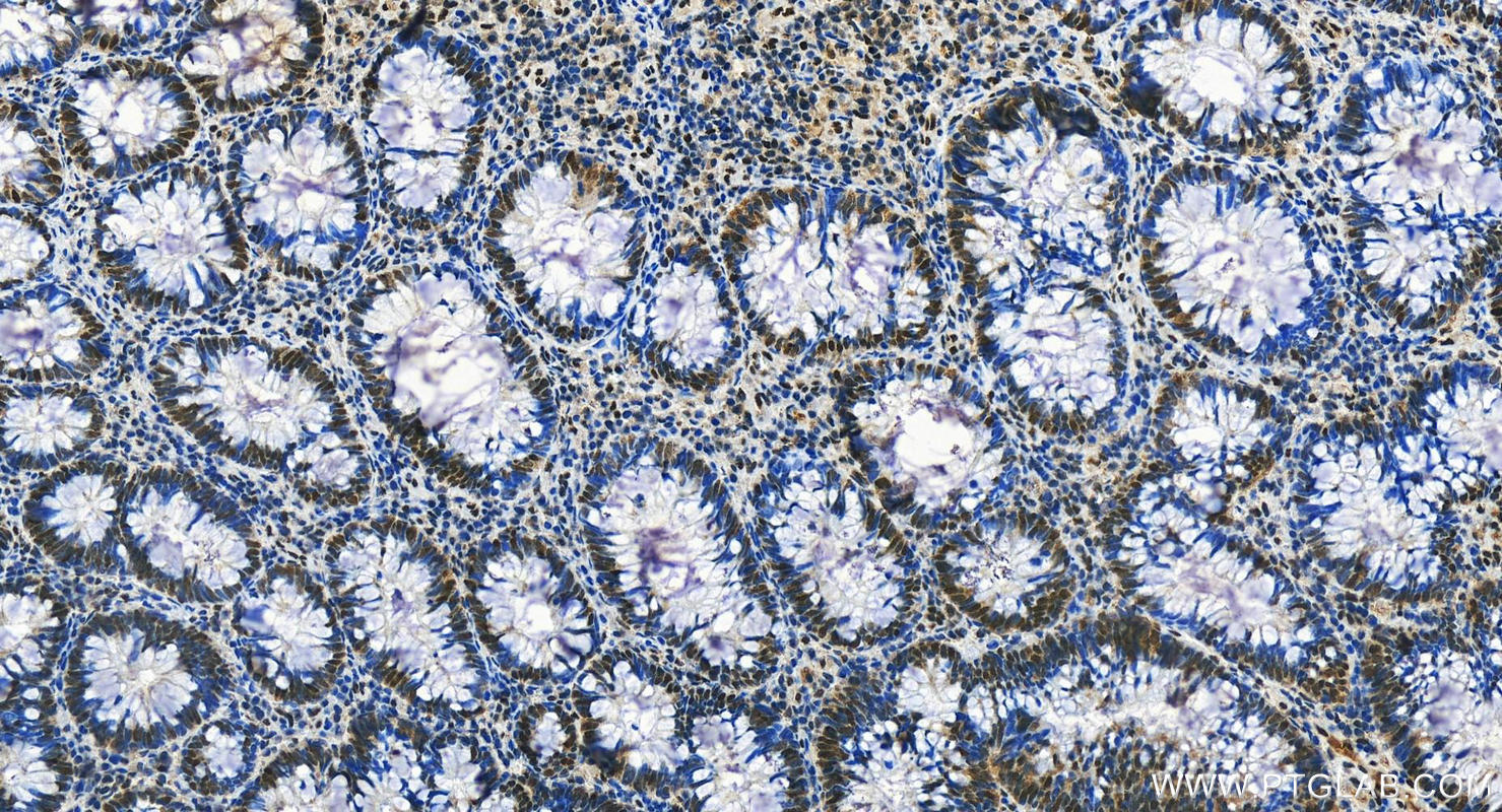 IHC staining of human colon cancer using 29338-1-AP (same clone as 29338-1-PBS)