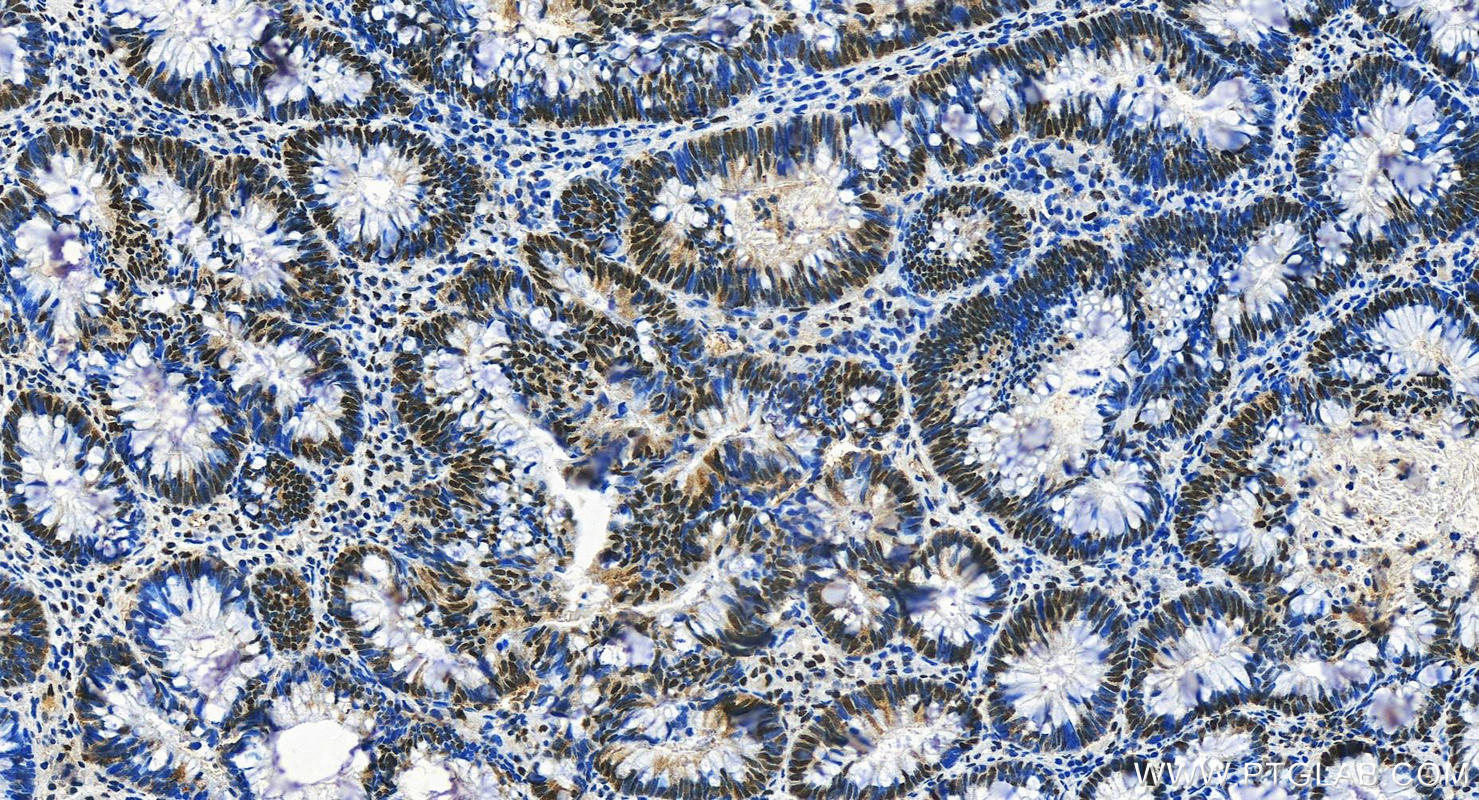 IHC staining of human colon cancer using 29338-1-AP (same clone as 29338-1-PBS)