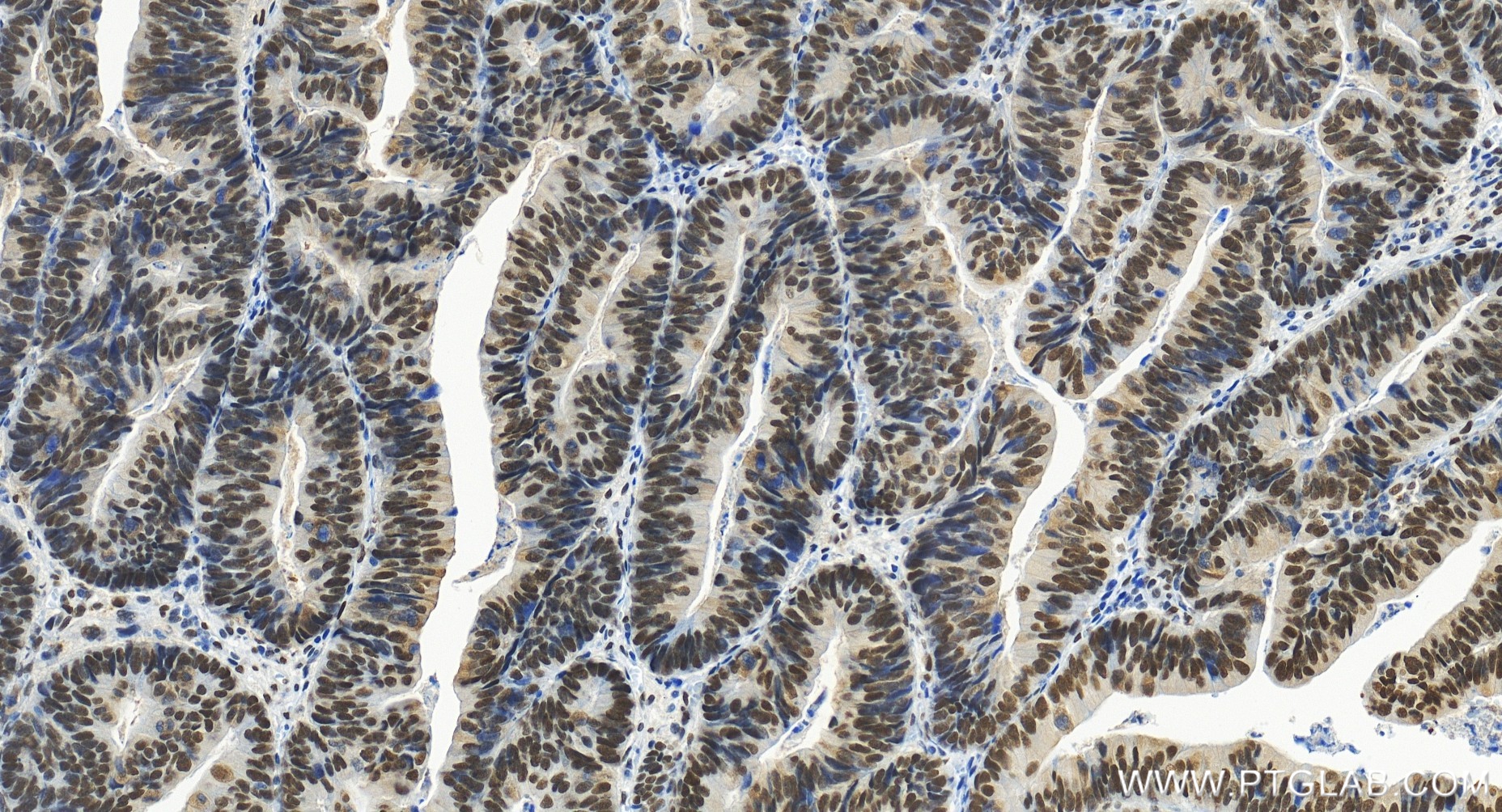 Immunohistochemical analysis of paraffin-embedded human colon cancer tissue slide using 86452-1-RR (FOXK1 antibody) at dilution of 1:500 (under 20x lens). Heat mediated antigen retrieval with Tris-EDTA buffer (pH 9.0). IHC staining of human colon cancer using 86452-1-RR