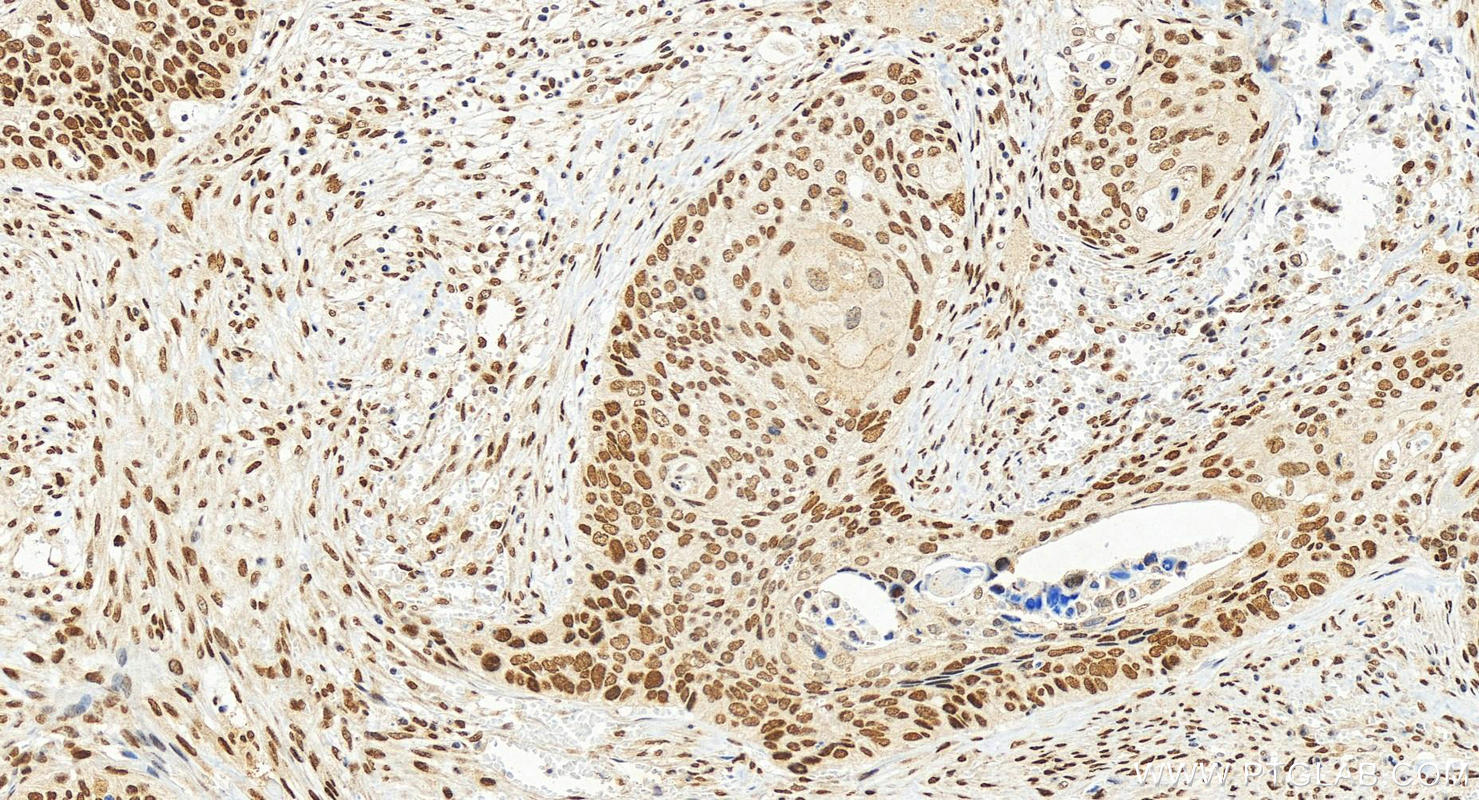 Immunohistochemical analysis of paraffin-embedded human cervical squamous cancer tissue slide using 30660-1-AP (FOXK2 antibody) at dilution of 1:1000 (under 20x lens). Heat mediated antigen retrieval with Tris-EDTA buffer (pH 9.0). IHC staining of human cervical squamous cancer using 30660-1-AP