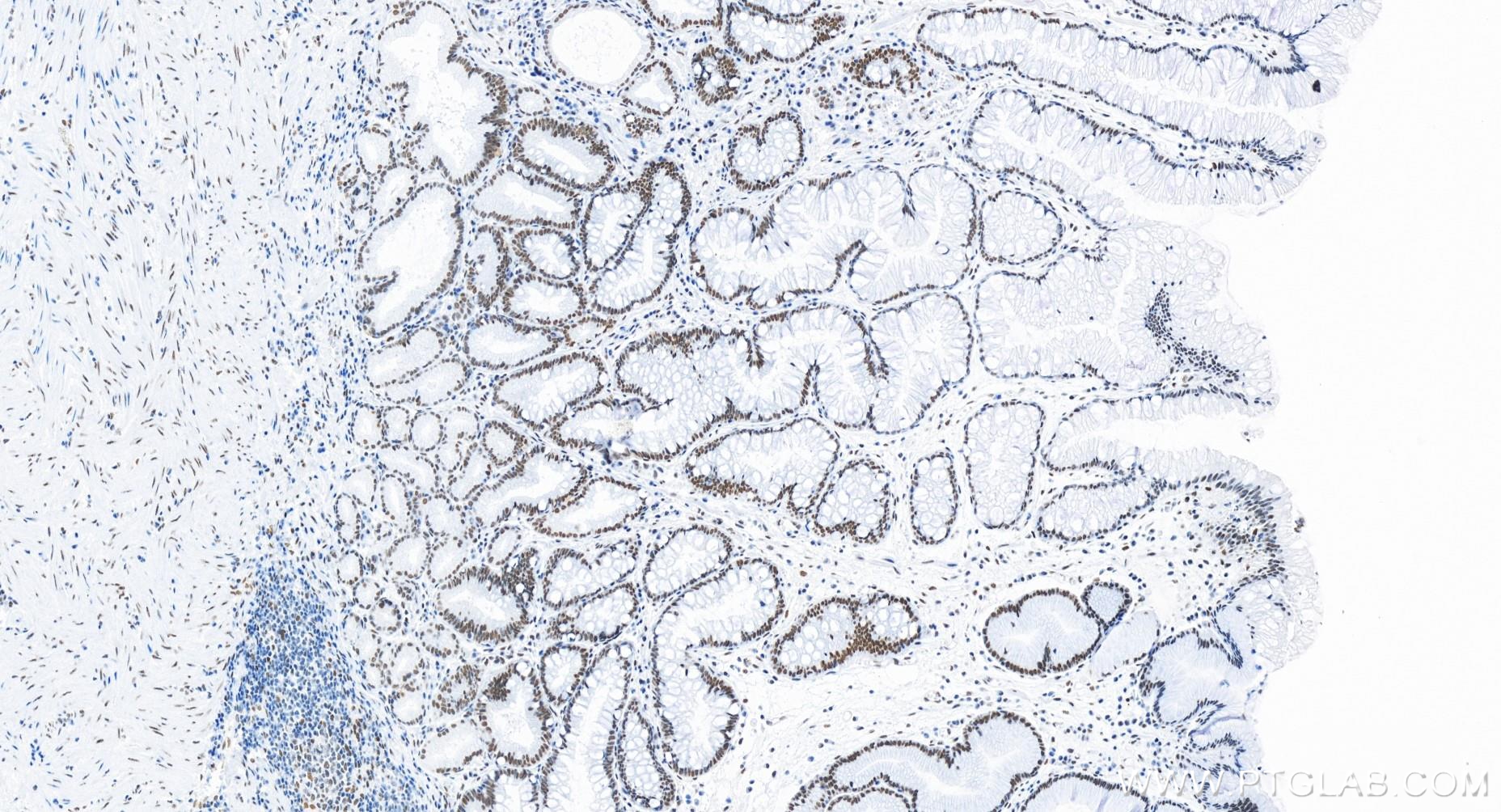 IHC staining of human stomach cancer using 83735-6-RR
