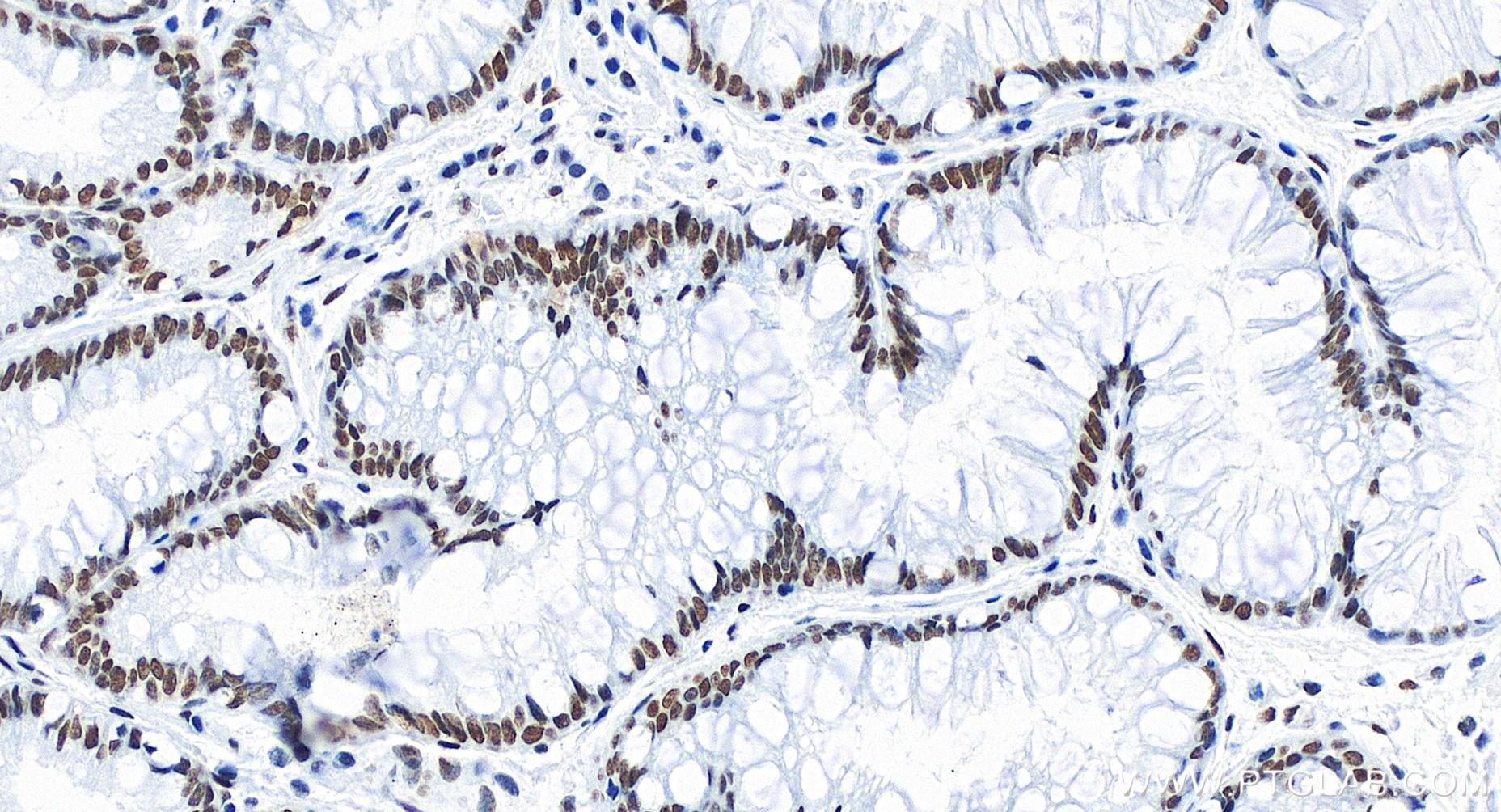 IHC staining of human stomach cancer using 83735-6-RR