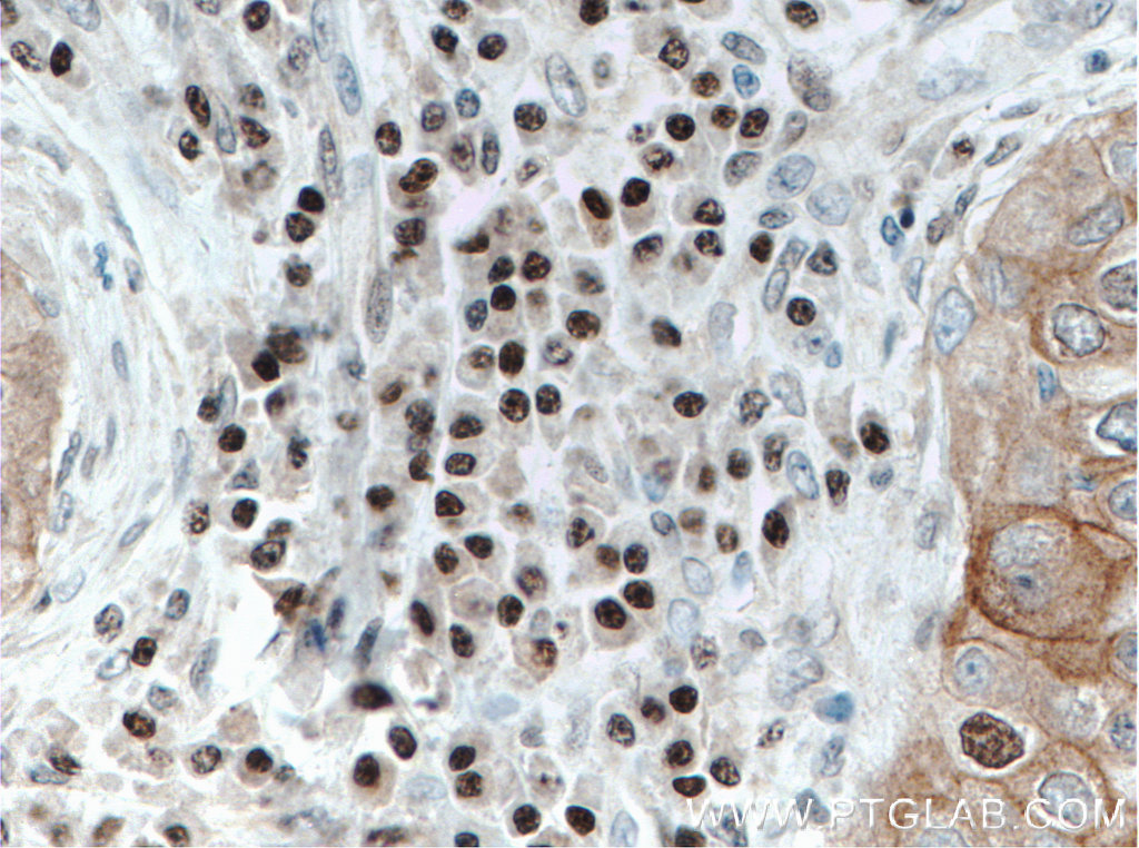 IHC staining of human breast cancer using 66428-1-Ig (same clone as 66428-1-PBS)