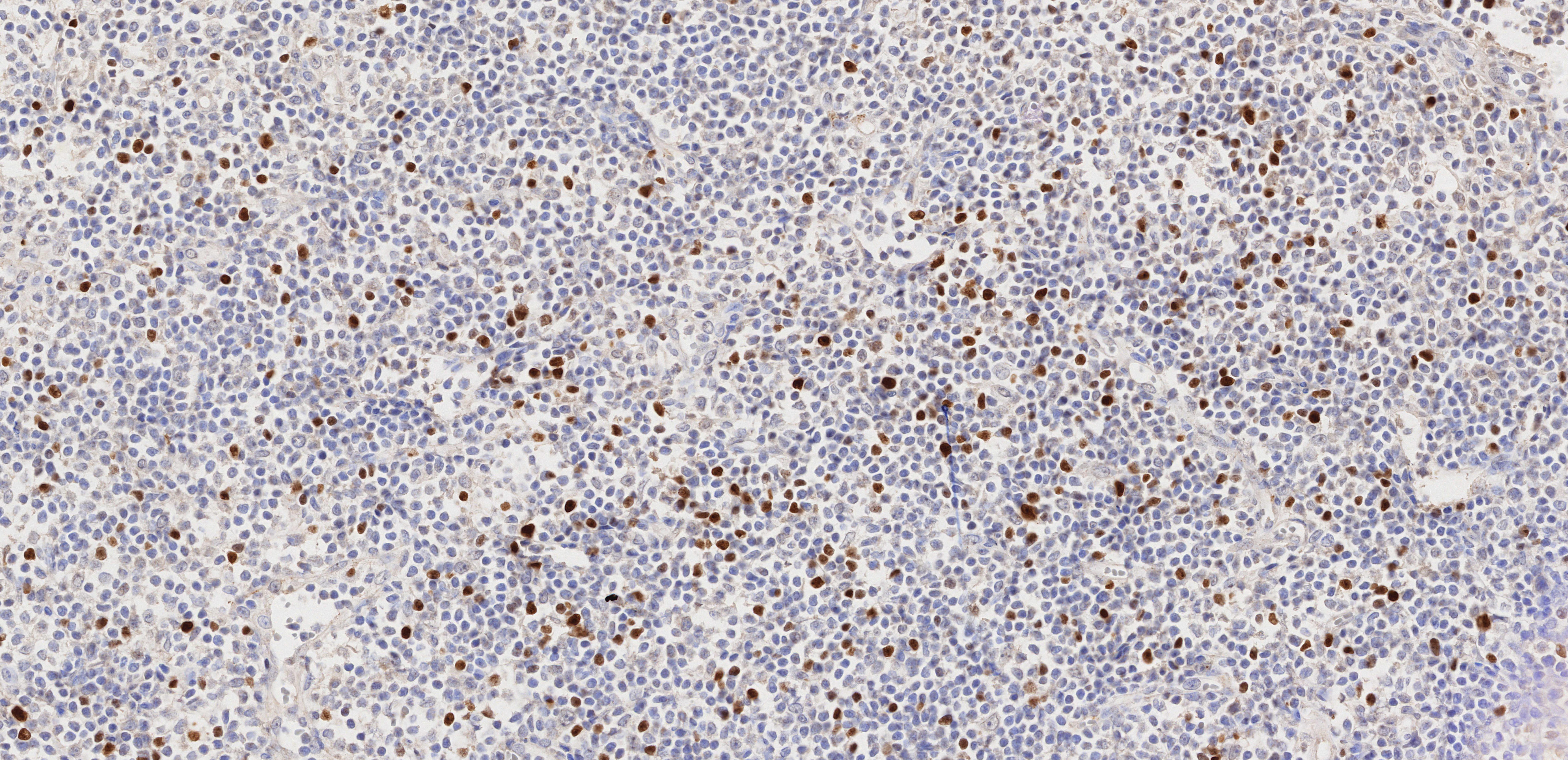 IHC staining of human appendicitis using 68803-2-Ig (same clone as 68803-2-PBS)