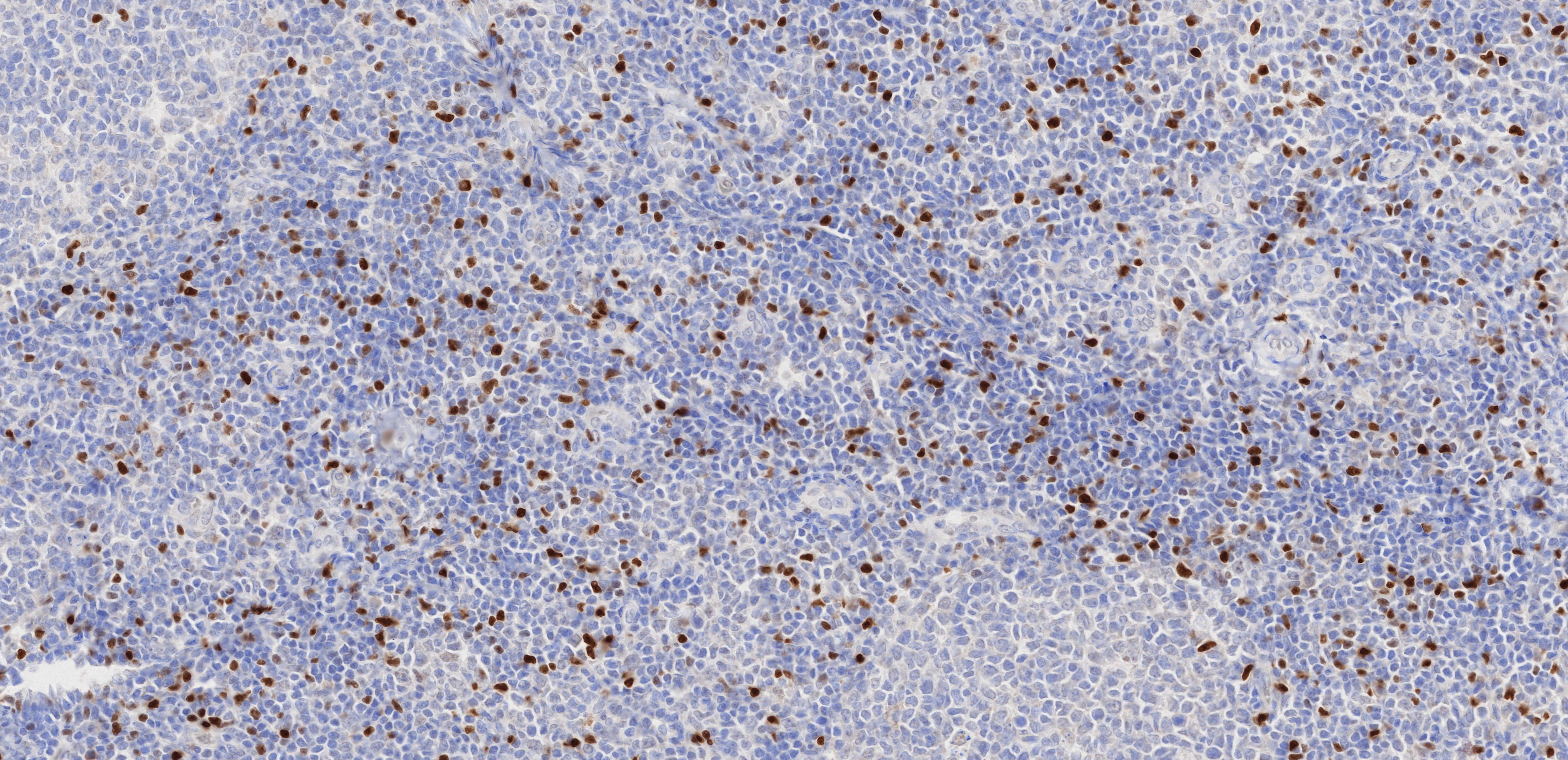 IHC staining of human tonsillitis using 68803-2-Ig (same clone as 68803-2-PBS)