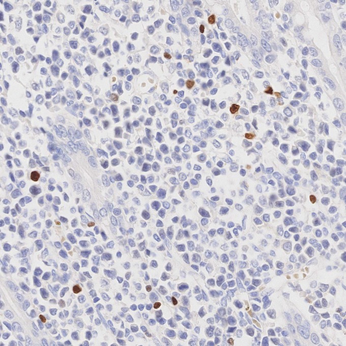IHC staining of human lymphoma using 68803-2-Ig