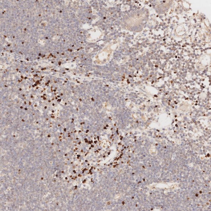 IHC staining of human lymphoma using 68803-2-Ig
