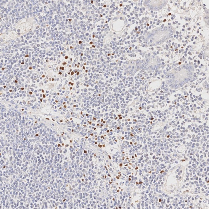 IHC staining of human lymphoma using 68803-2-Ig