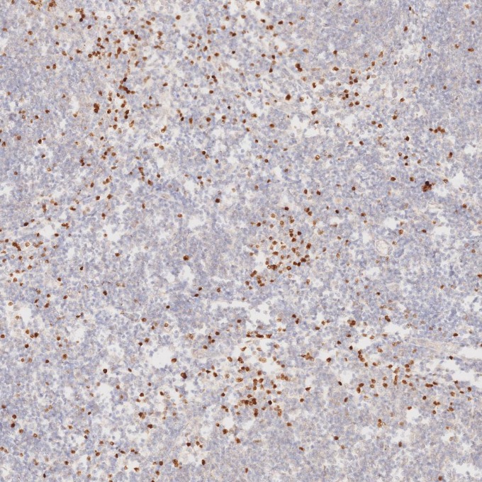 IHC staining of human lymphoma using 68803-2-Ig