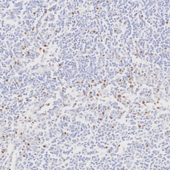 IHC staining of human lymphoma using 68803-2-Ig