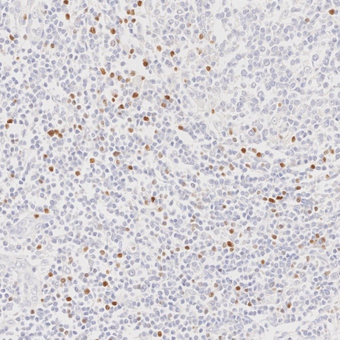 IHC staining of human lymphoma using 68803-2-Ig