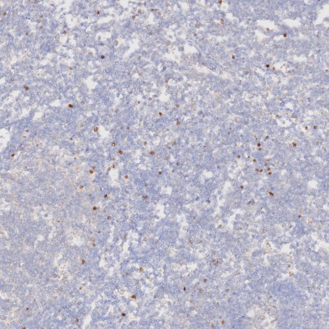 IHC staining of human tonsillitis using 68803-2-Ig
