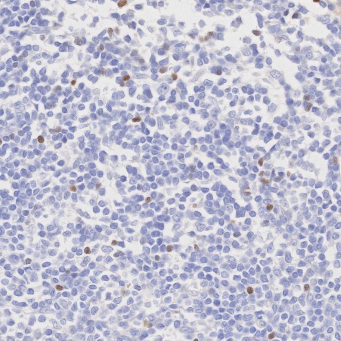 IHC staining of human tonsillitis using 68803-2-Ig