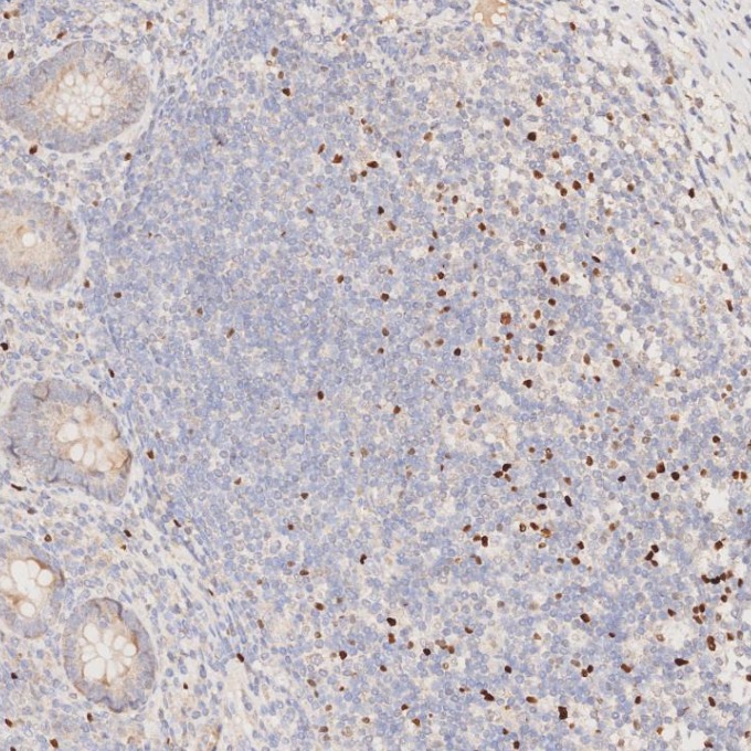 IHC staining of human appendicitis using 68803-2-Ig