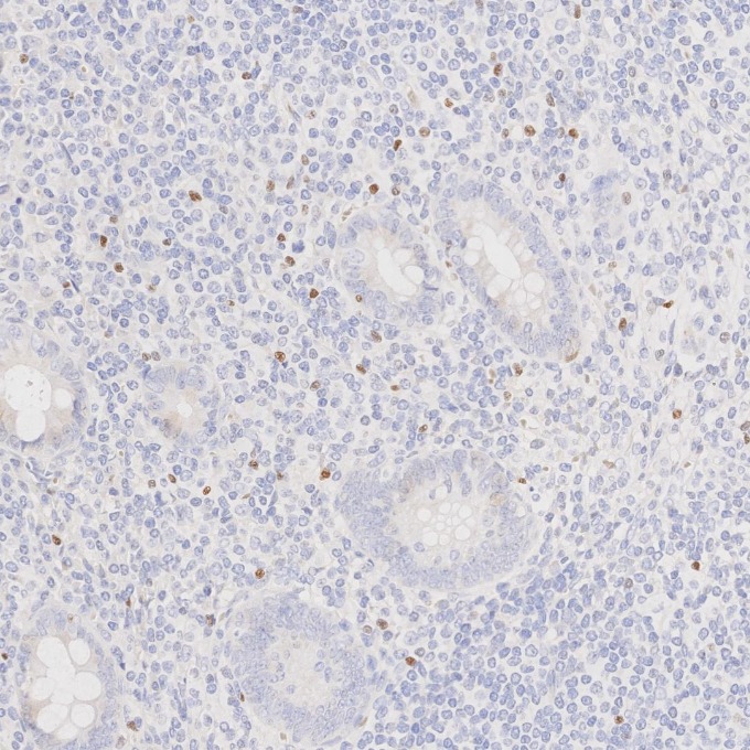 IHC staining of human appendicitis using 68803-2-Ig