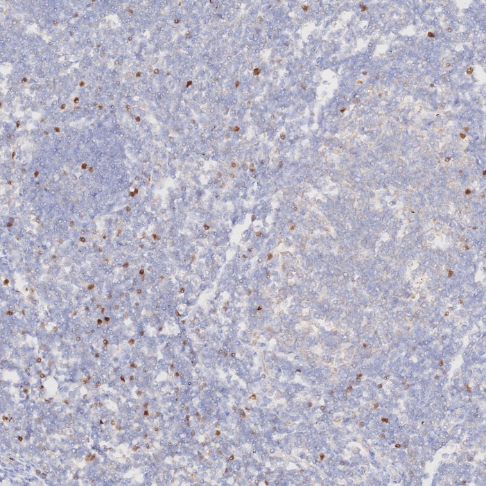 IHC staining of human tonsillitis using 68803-2-Ig
