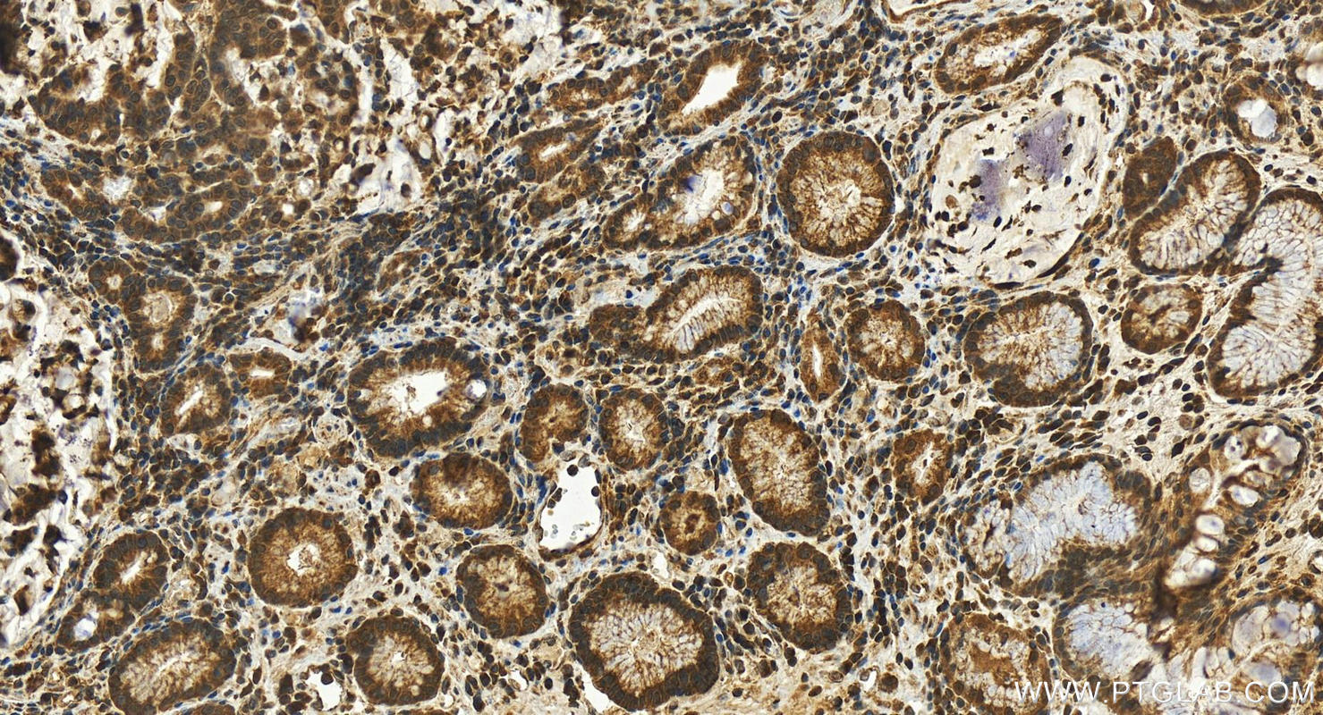 IHC staining of human stomach cancer using 23718-1-AP