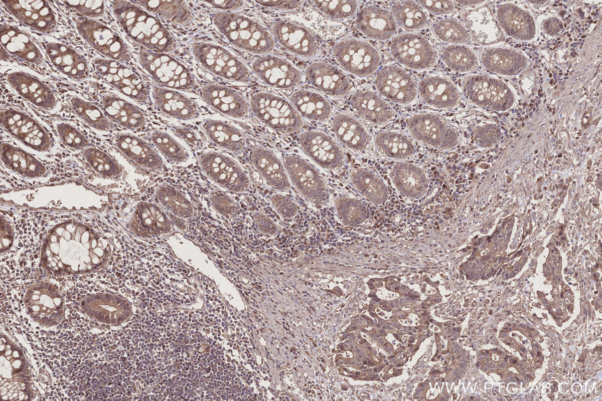 IHC staining of human rectal cancer using 11503-1-AP