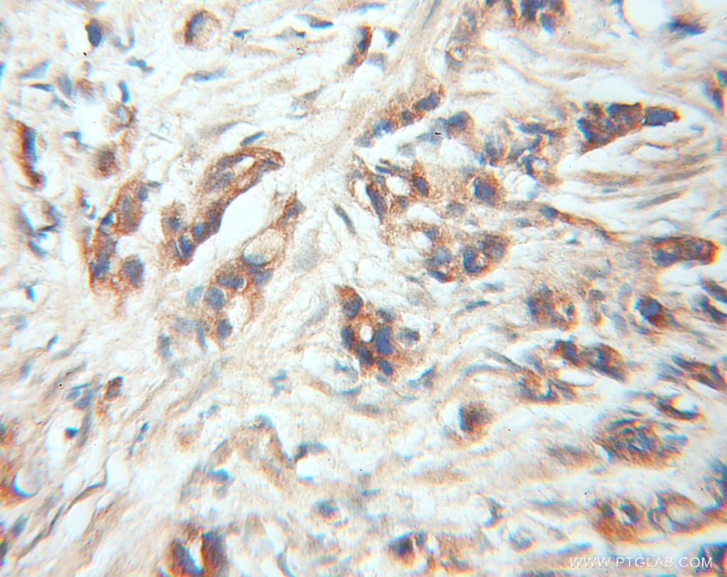 IHC staining of human prostate cancer using 11503-1-AP