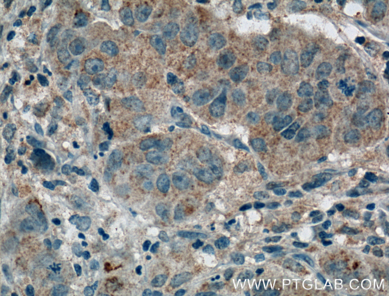 IHC staining of human prostate cancer using 66263-1-Ig