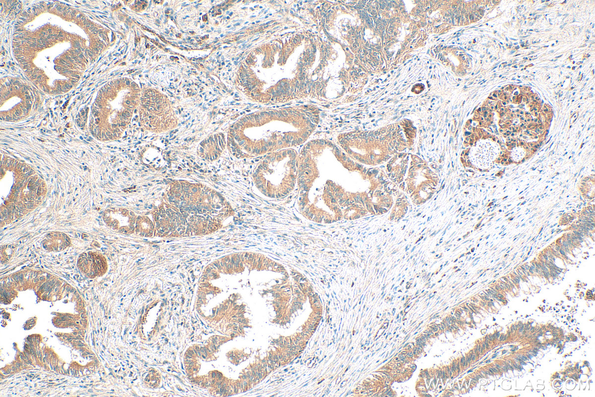 IHC staining of human pancreas cancer using 32075-1-AP
