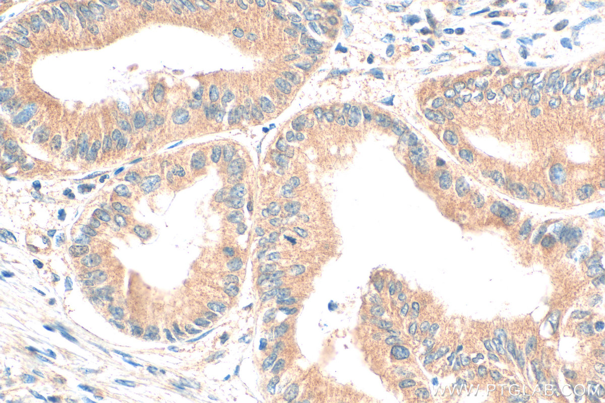 IHC staining of human pancreas cancer using 32075-1-AP