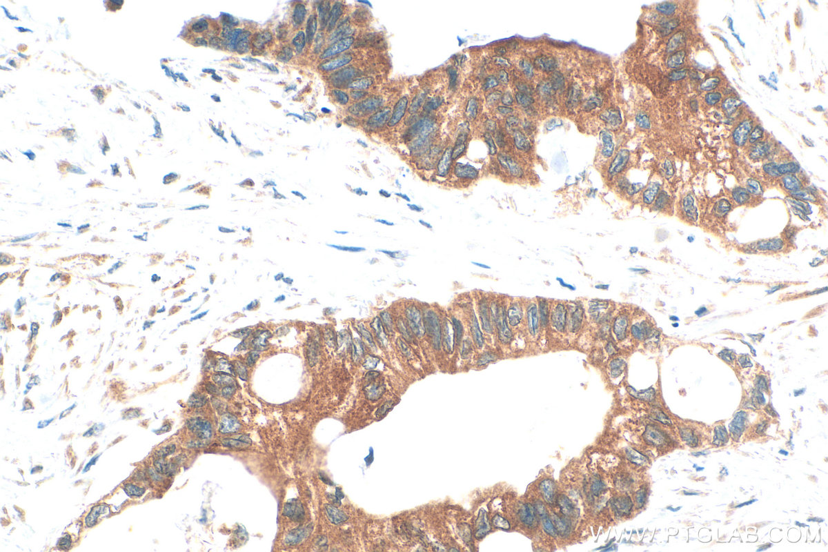 IHC staining of human urothelial carcinoma using 32075-1-AP