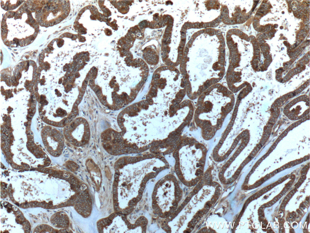IHC staining of human ovary tumor using 60060-1-Ig