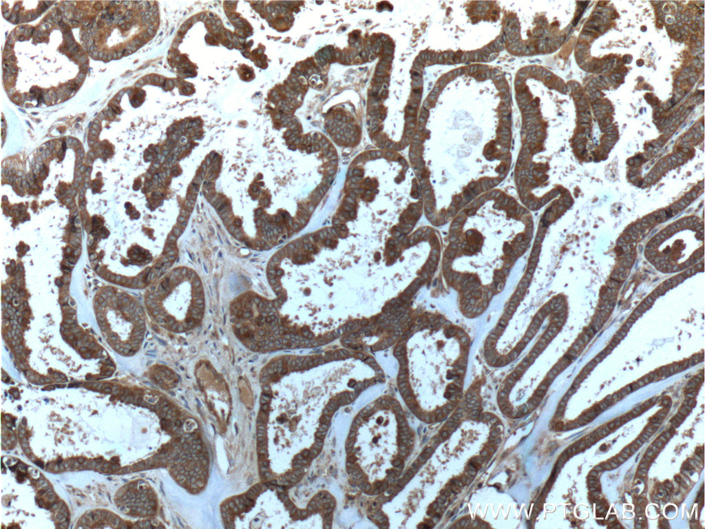 IHC staining of human ovary tumor using 60060-1-Ig