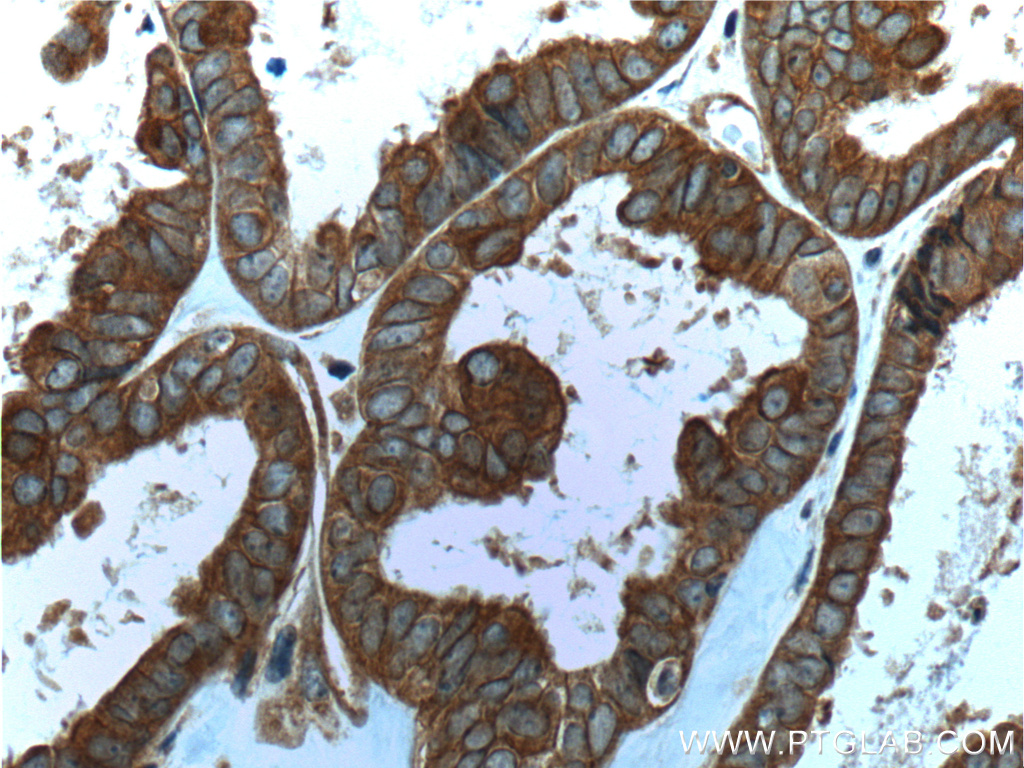 IHC staining of human ovary tumor using 60060-1-Ig